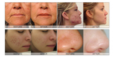 Hydra Dermabrasion facial Machine